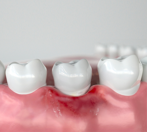 periodoncia en Madrid