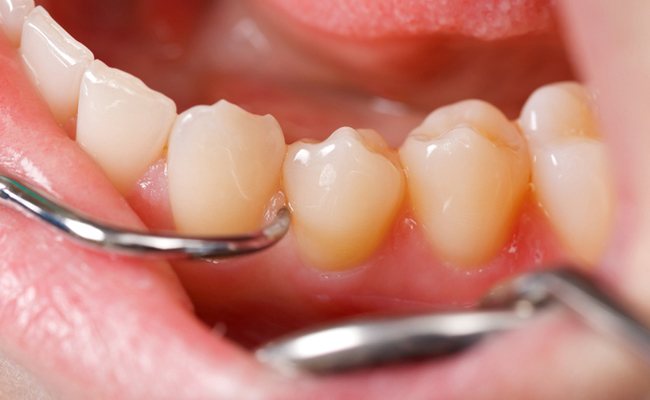 periodoncia en Madrid