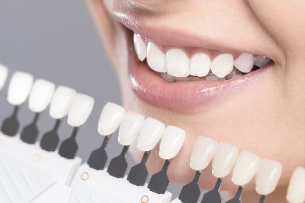Estética dental para la época estival